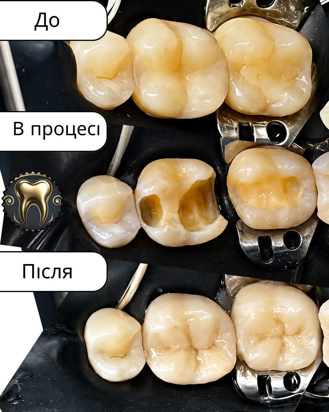 Лікування карієсу та реставрація — робота 2 — фото до та після лікування